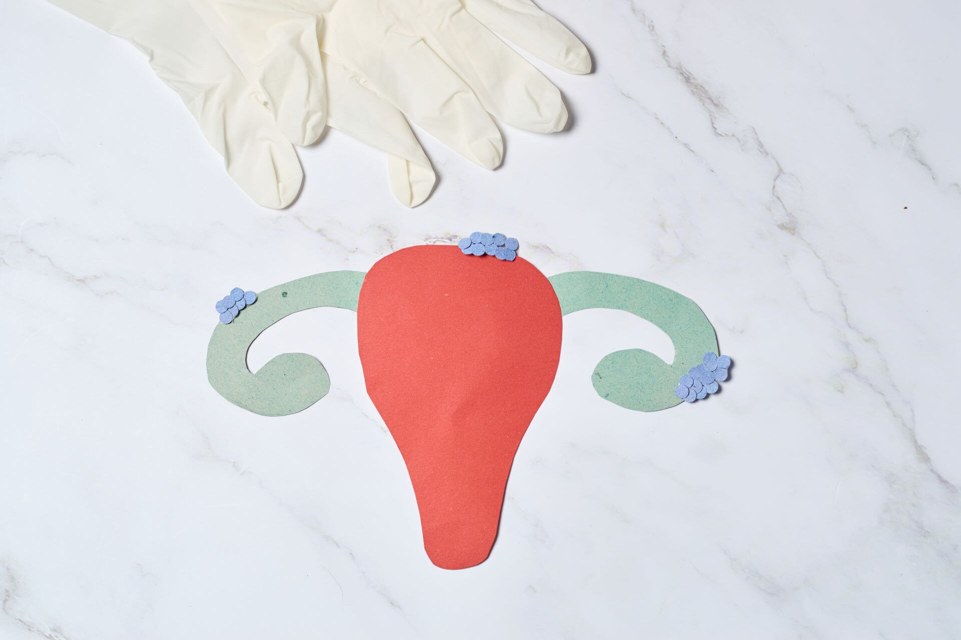 Você está visualizando atualmente Quando fazer colonoscopia na endometriose?